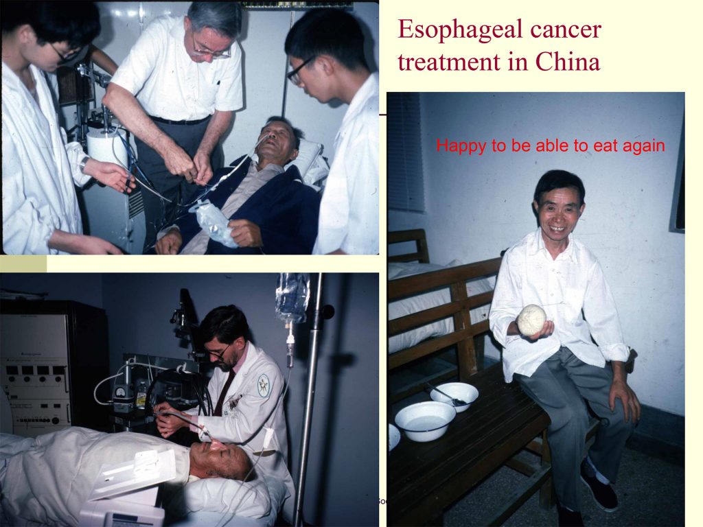 Esophageal cancer treatment in China, 1994